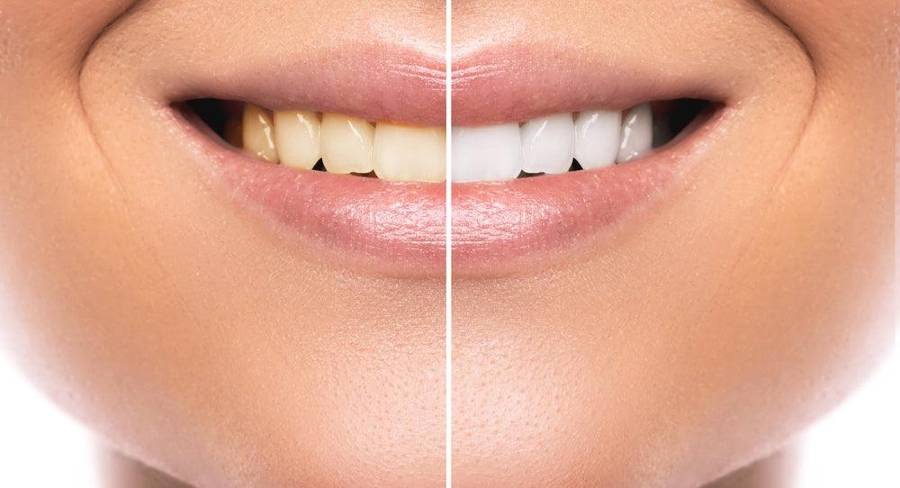 The Pros and Cons of Different Teeth Whitening Procedures - SmilePro