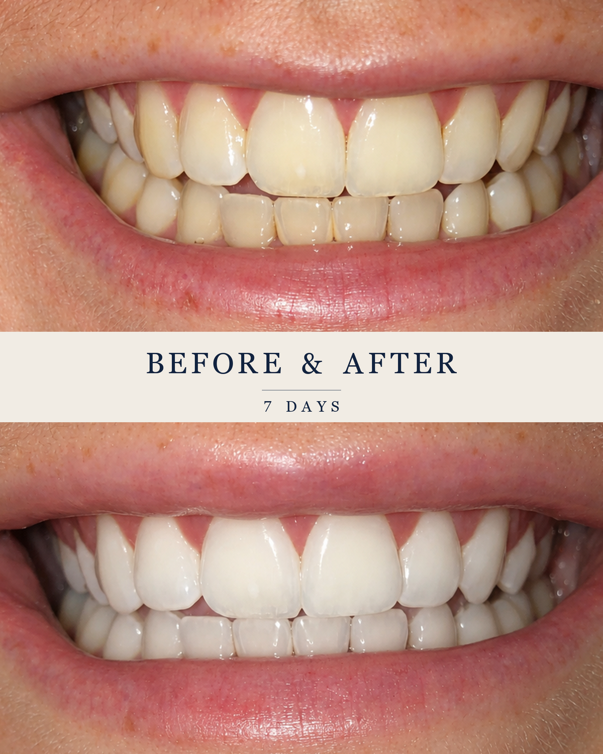 Upper and lower teeth photographed before and after seven days of SmilePro whitening.